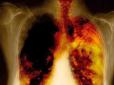 Хіти тижня. Запобігти найгіршому: Медики розповіли, як хворий може самостійно розпізнати рак легенів на ранній стадії