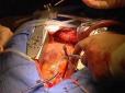 ​Австралійські хірурги вперше в історії медицини загасили вогонь у грудях пацієнта