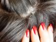 Як швидко та ефективно позбутися лупи: Дерматолог дала професійні поради щодо найпоширенішого захворювання шкіри голови