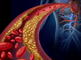 Ви будете здивовані! Кардіологи назвали єдину річ, яка насправді зменшує накопичення бляшок в артеріях