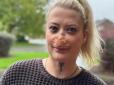 Хотіла зекономити: Лікування зубів у Туреччині обернулося для пацієнтки щоденними стражданнями